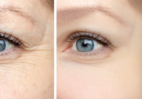 All you need to know about Under Eye Wrinkles and Fine Lines